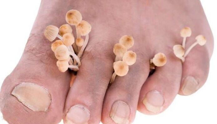 fungus between the toes