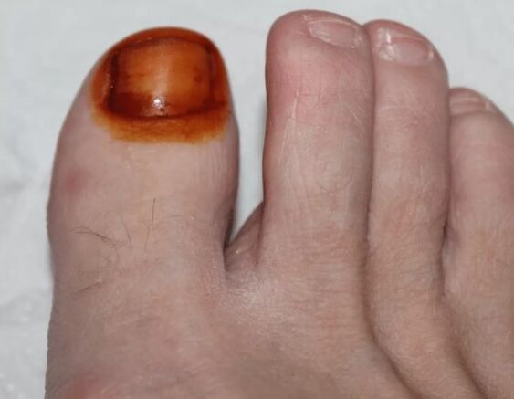 Fungus treatment iodine