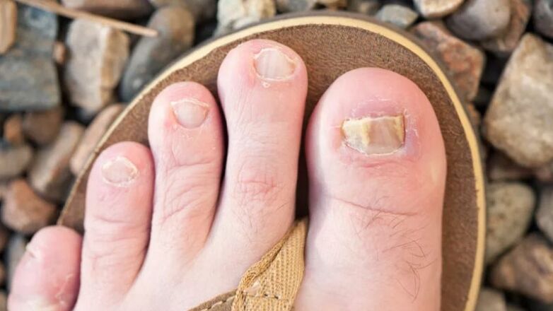 Mycosis of the nails