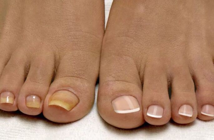 The fungus of the feet