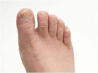 symptoms of fungus on the feet