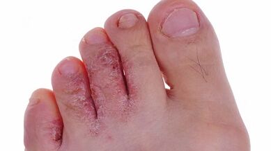 Types and stages of leg fungus development