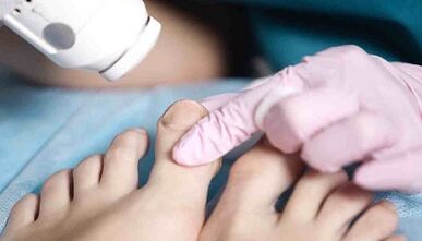 hardware treatment of fungi on the feet