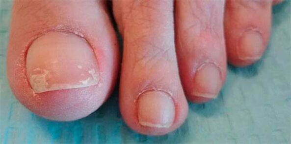 Stages of fungal legs