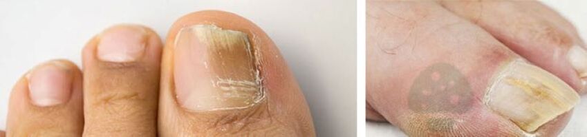 The fungus of the toe of the toe