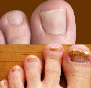 initial and advanced stage of foot fungus