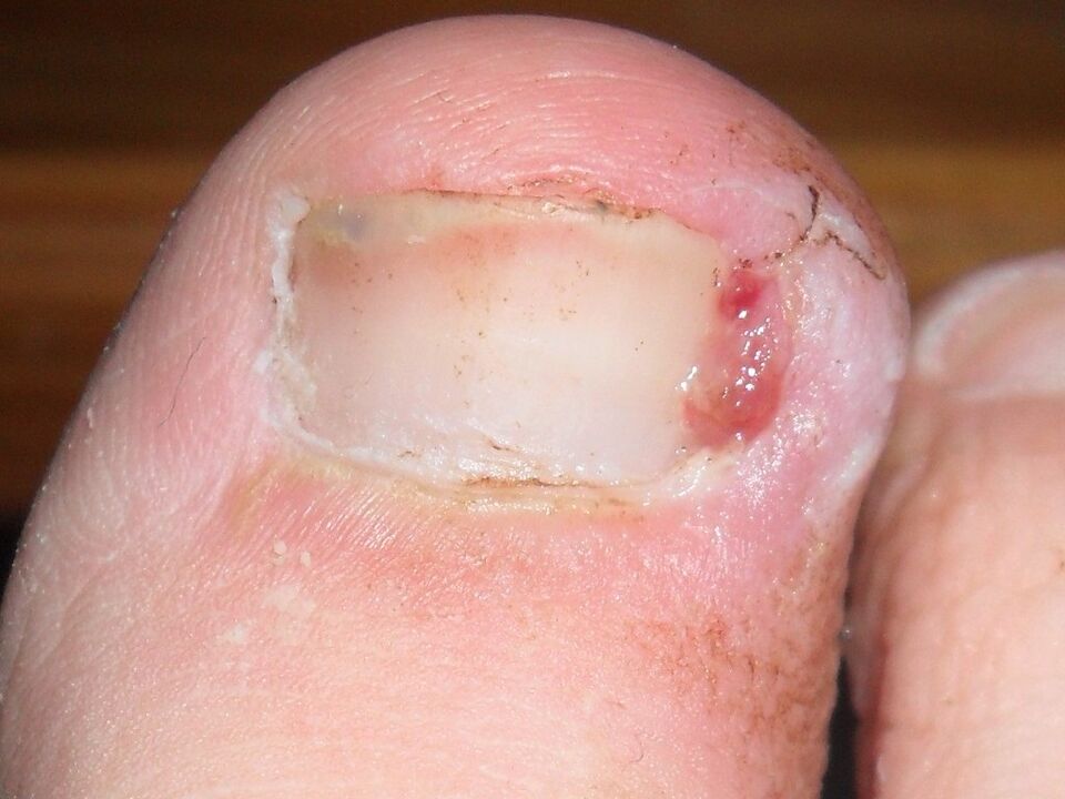 an ingrown toenail as a symptom of a fungal infection