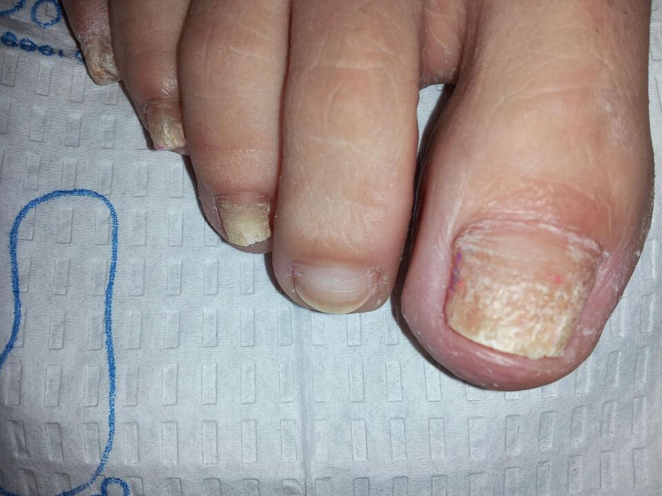 how to treat toenail fungus with jalapenos