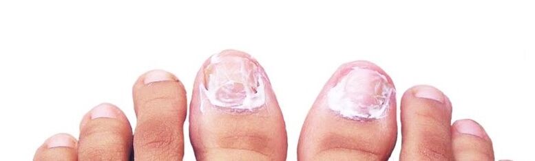 nail fungus ointment
