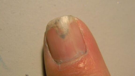 nail fungus symptoms
