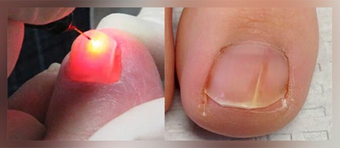laser therapy