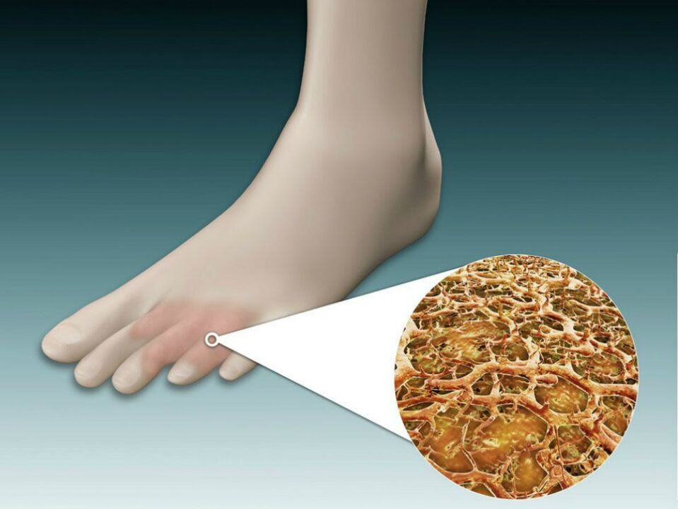 Redness of the skin between and near the toes with intertriginous fungus